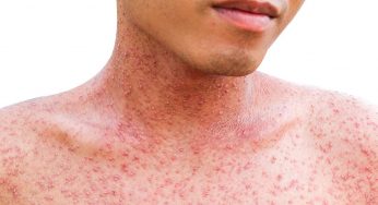 Ситуация с корью в Гродно: уже 11 подтвержденных случаев