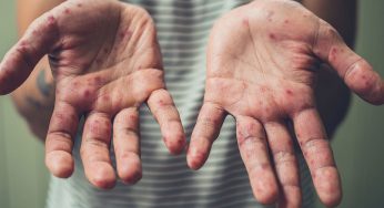 В Гродно лабораторно подтверждены два случая кори. Эксперты советуют сделать прививку